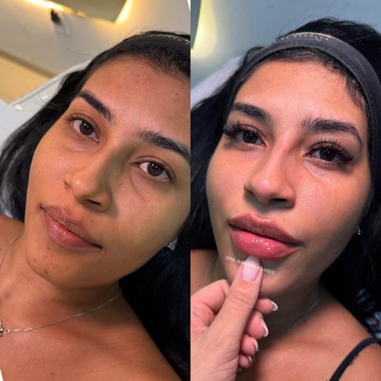 Antes e depois — resultado 10