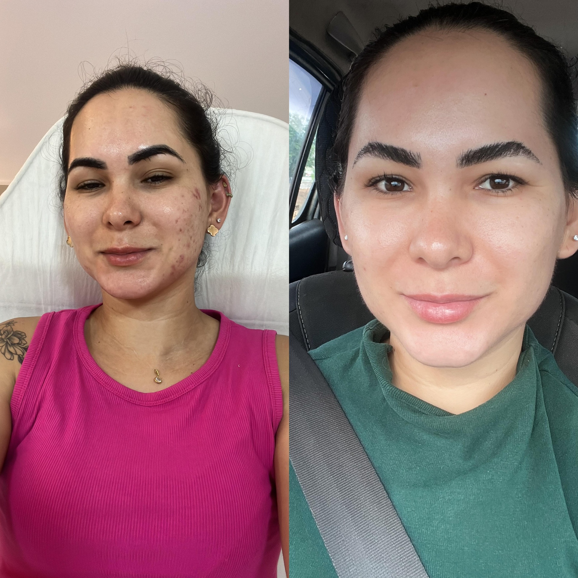 Antes e depois — resultado 3