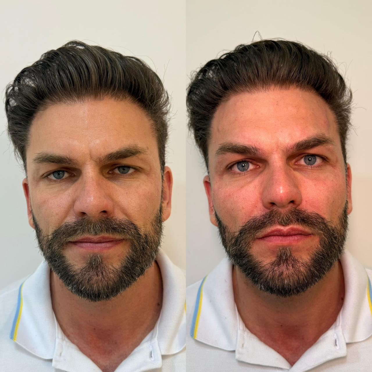 Antes e depois — resultado 4