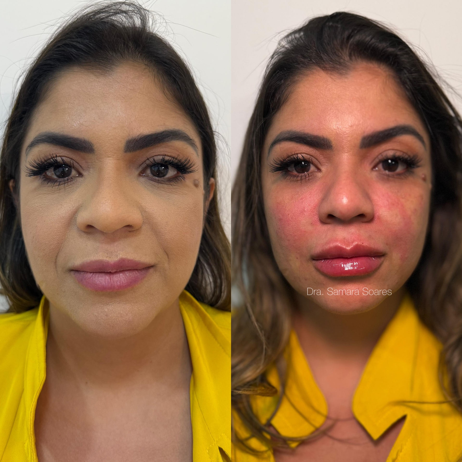 Antes e depois — resultado 5