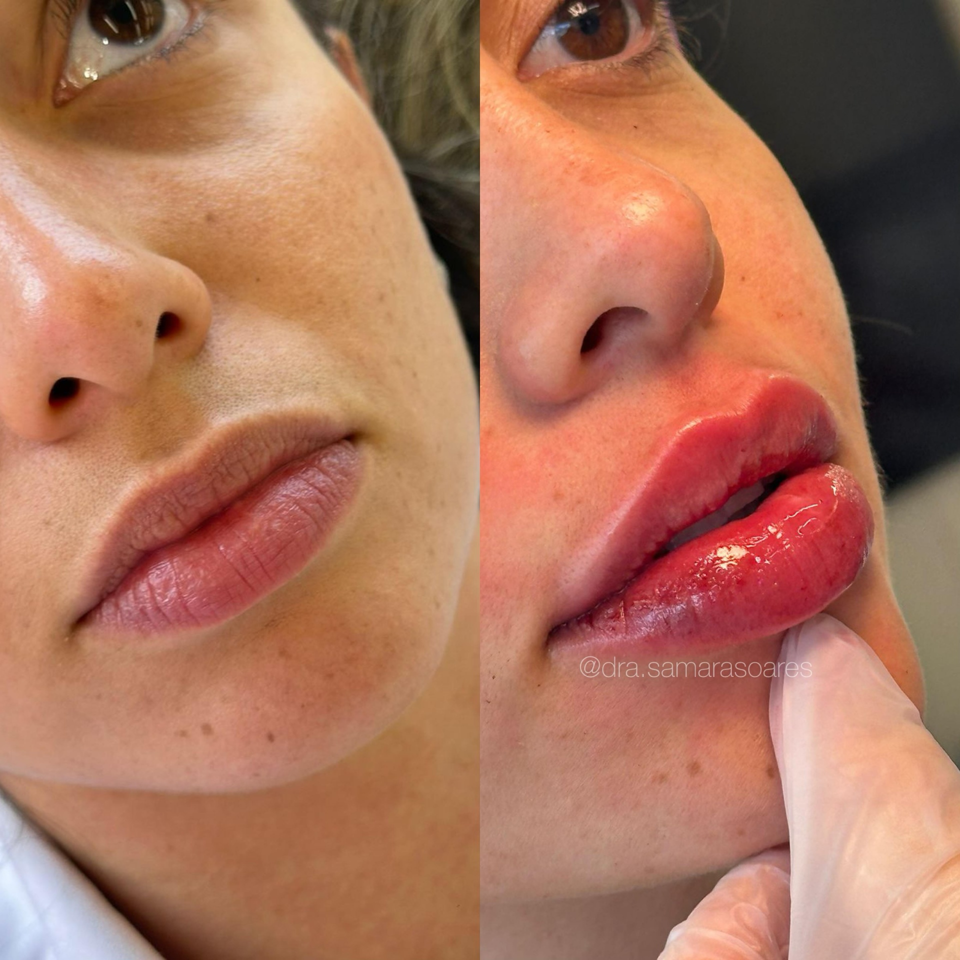 Antes e depois — resultado 6