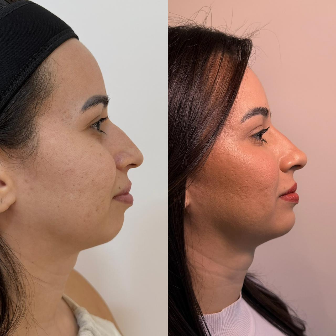 Antes e depois — resultado 7