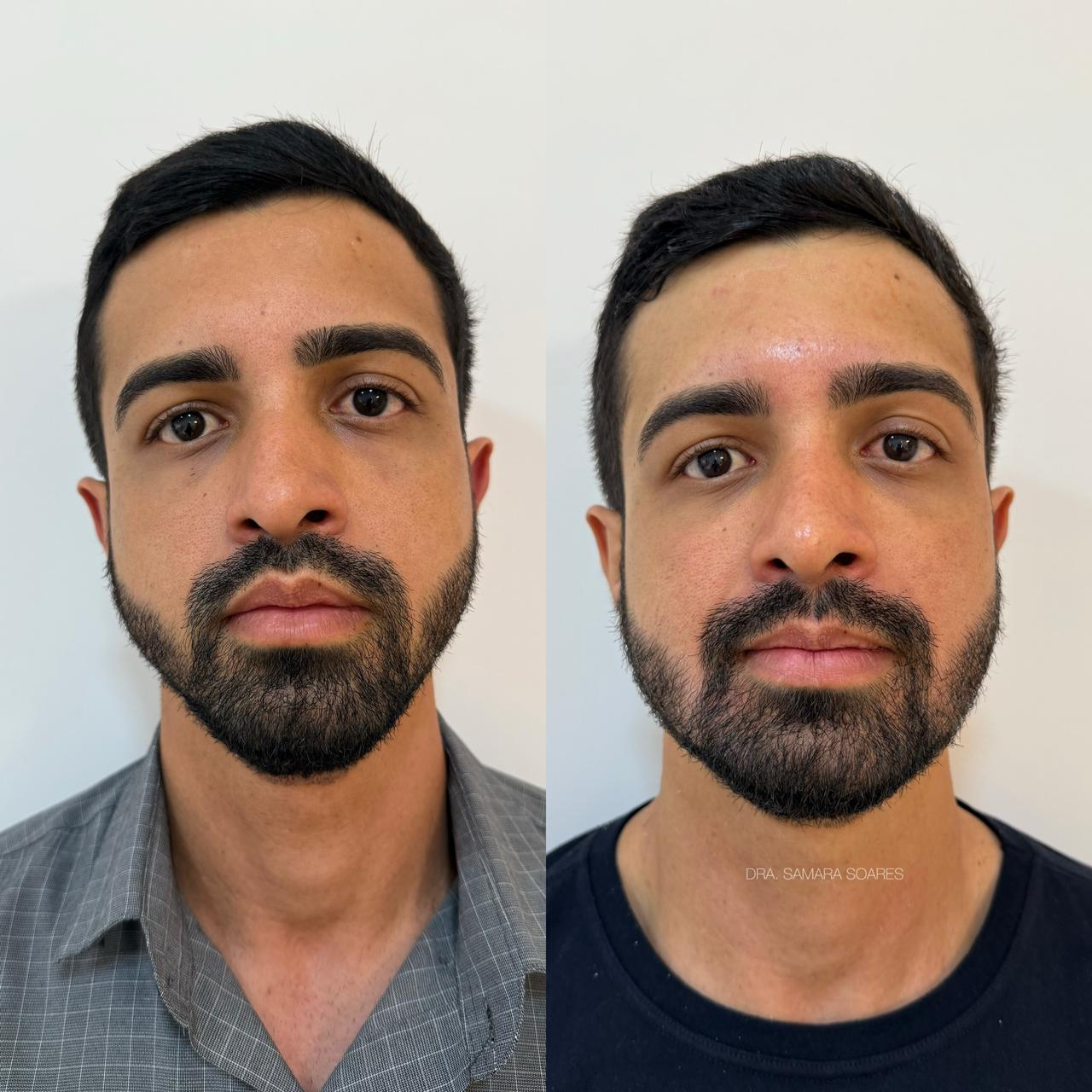 Antes e depois — resultado 9